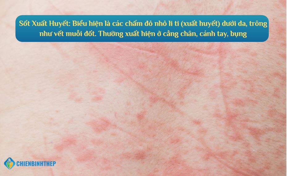 Sốt Xuất Huyết: Biểu hiện là các chấm đỏ nhỏ li ti (xuất huyết) dưới da