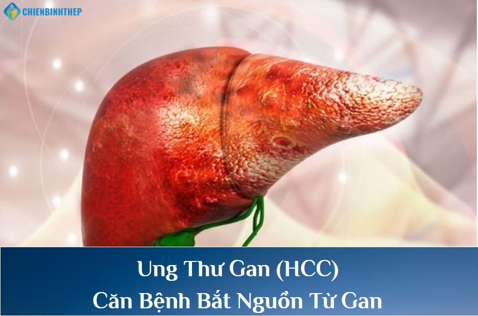 Ung Thư Gan (HCC) Là Gì? Nguyên Nhân Hàng Đầu