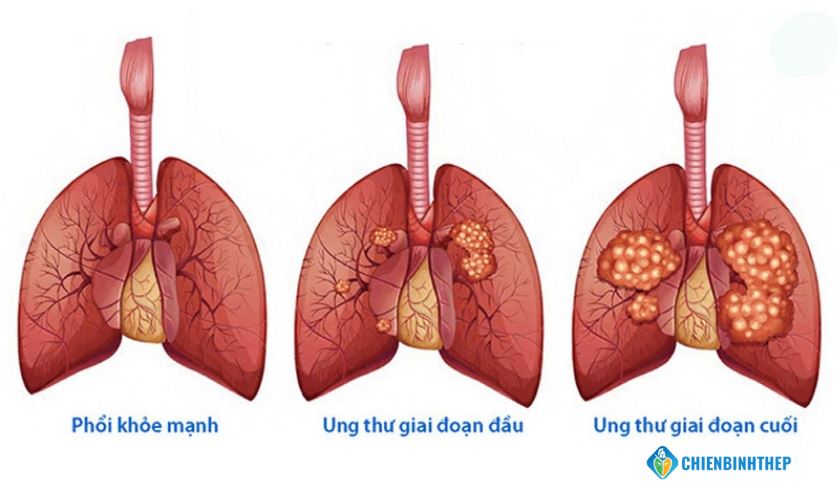 Ung thư phổi giai đoạn cuối