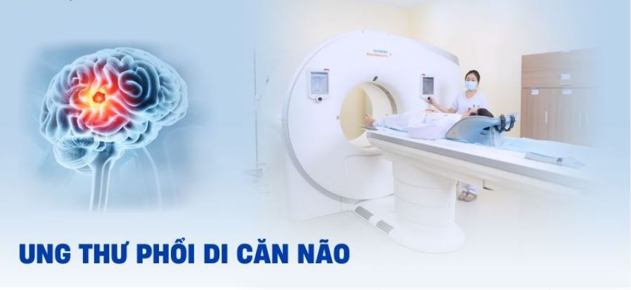 Xạ trị ung thư phổi di căn