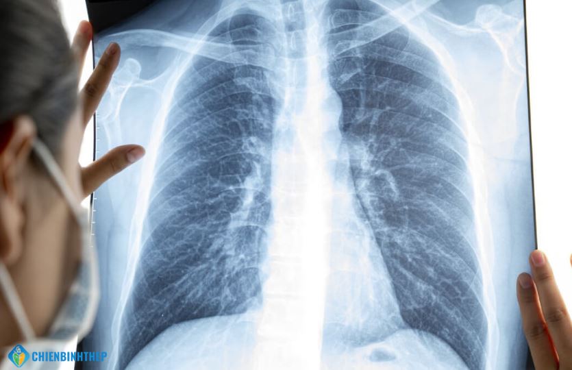 ung thư phổi di căn xương