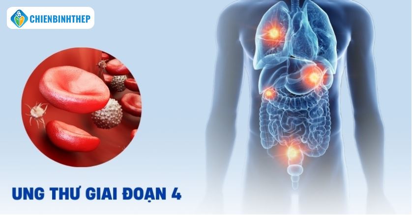 Ung thư phổi giai đoạn 4