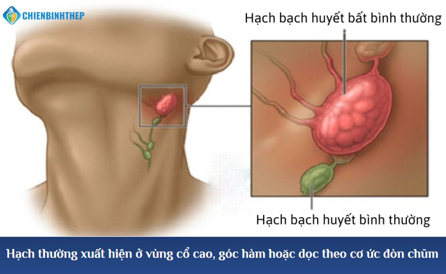 Hạch thường xuất hiện ở vùng cổ cao, góc hàm hoặc dọc theo cơ ức đòn chũm