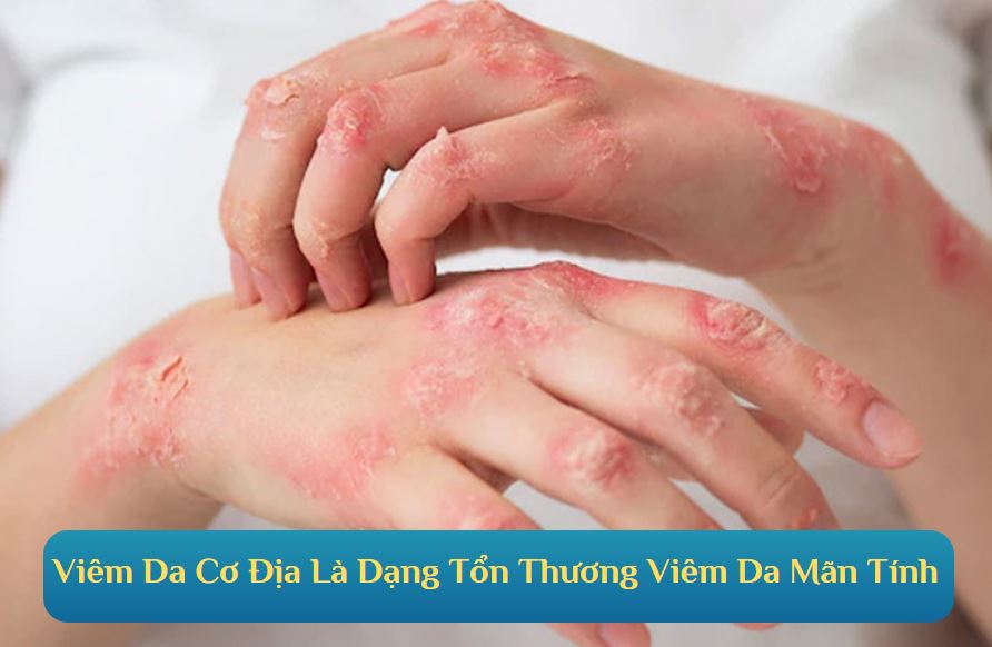 Viêm da cơ địa là gì