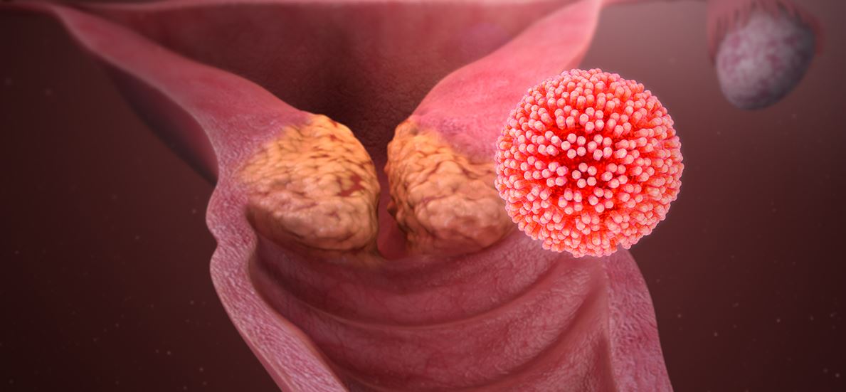 Virut HPV gây ung thư cổ tử cung