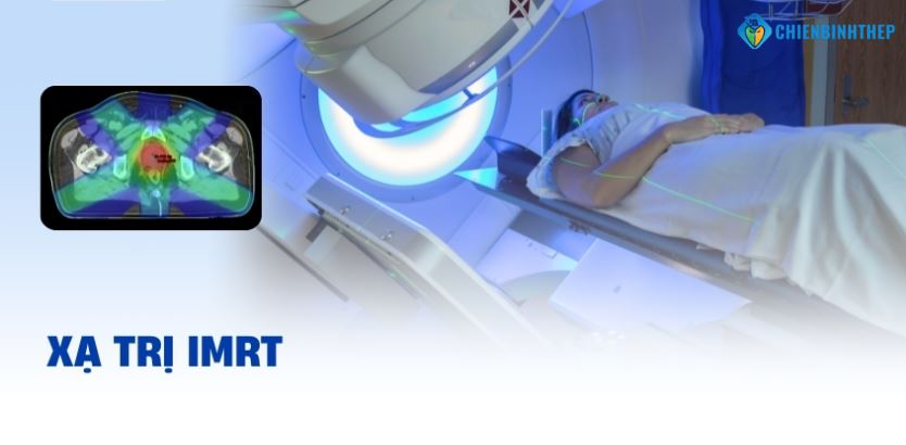 xạ trị IMRT