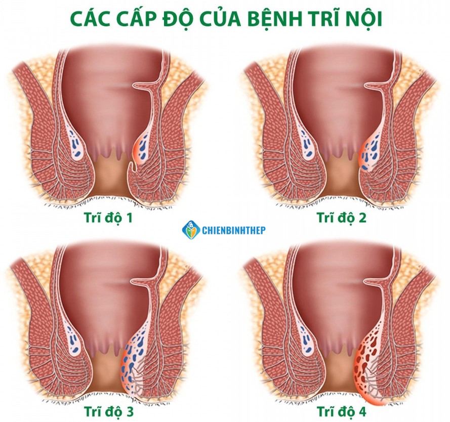 Các cấp độ của trĩ nội